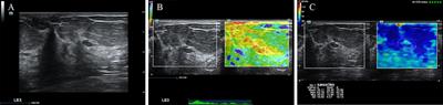 Clinical use and adjustment of ultrasound elastography for breast lesions followed WFUMB guidelines and recommendations in the real world